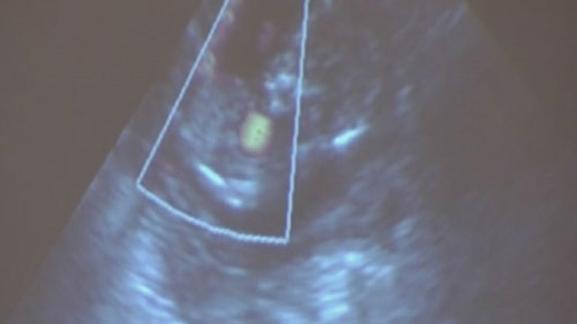 heartbeat-bill_219988