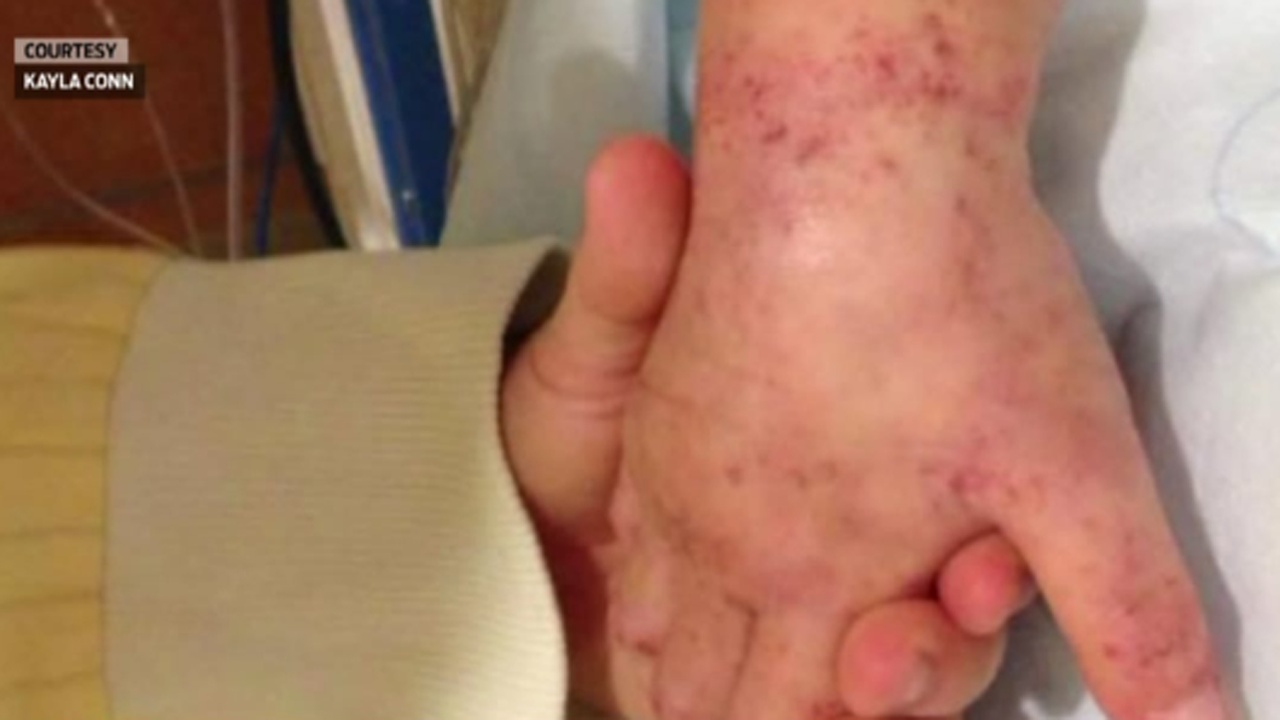girl-dies-after-tick-bite_316542