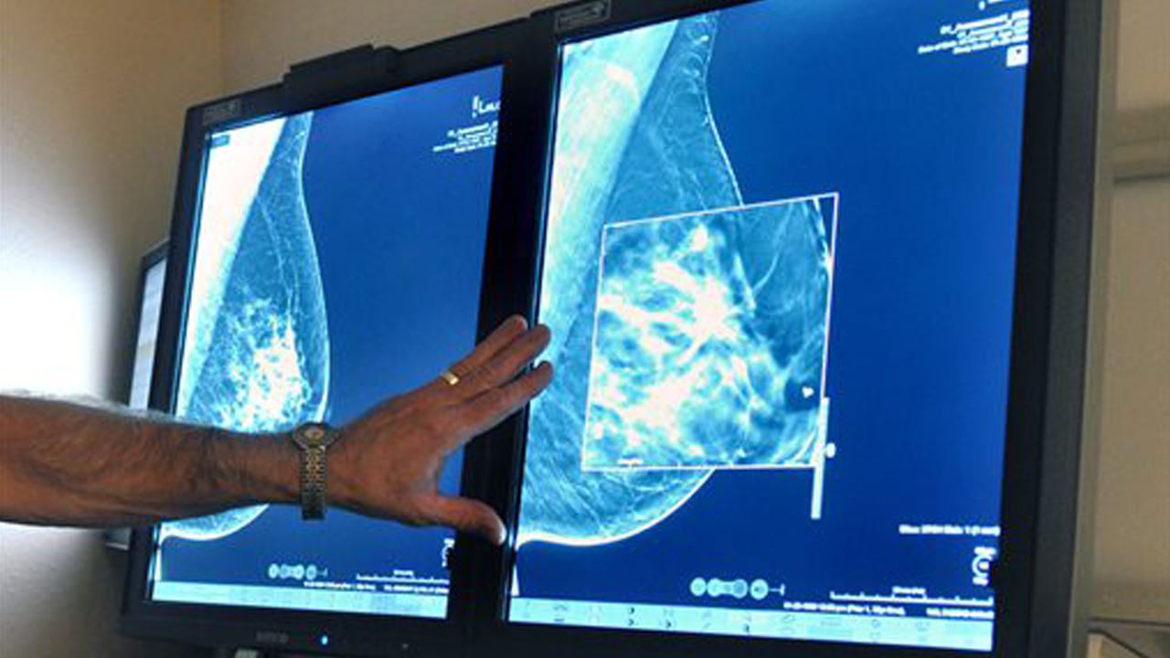 breastcancer_360292