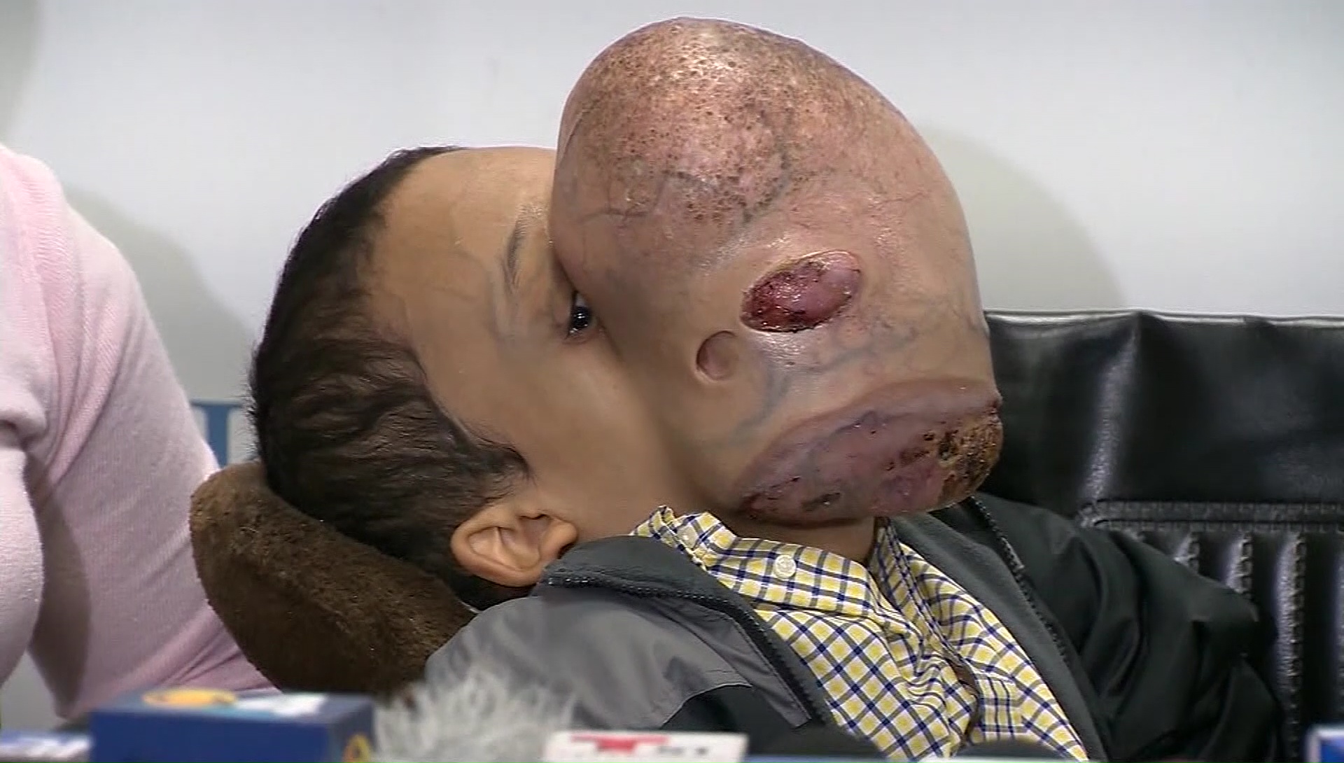 tumor on 14yo boy_374195