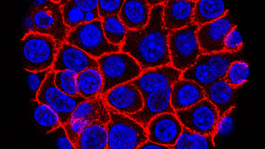 pancreatic-cancer_1528133888884.jpg