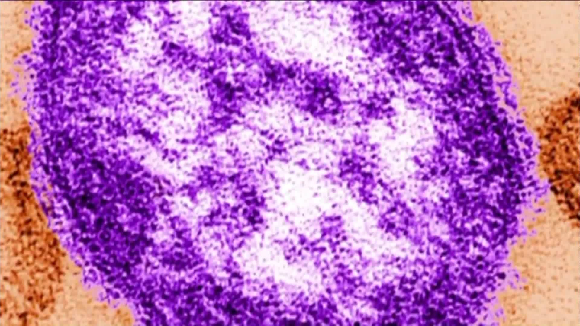 CDC__Measles_at_2nd_highest_level_in_US__2_20190415152413-846653543